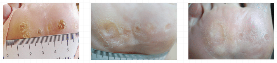 Plantar warts before and after Swift Microwave Therapy
