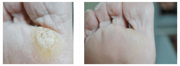 Plantar Warts before and after Swift Microwave Therapy