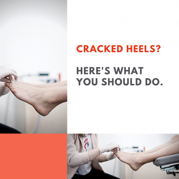 Cracked heels - what you should do