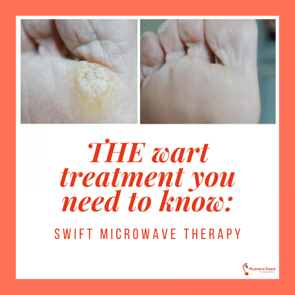 The Wart Treatment You Need to Know Swift Microwave Therapy