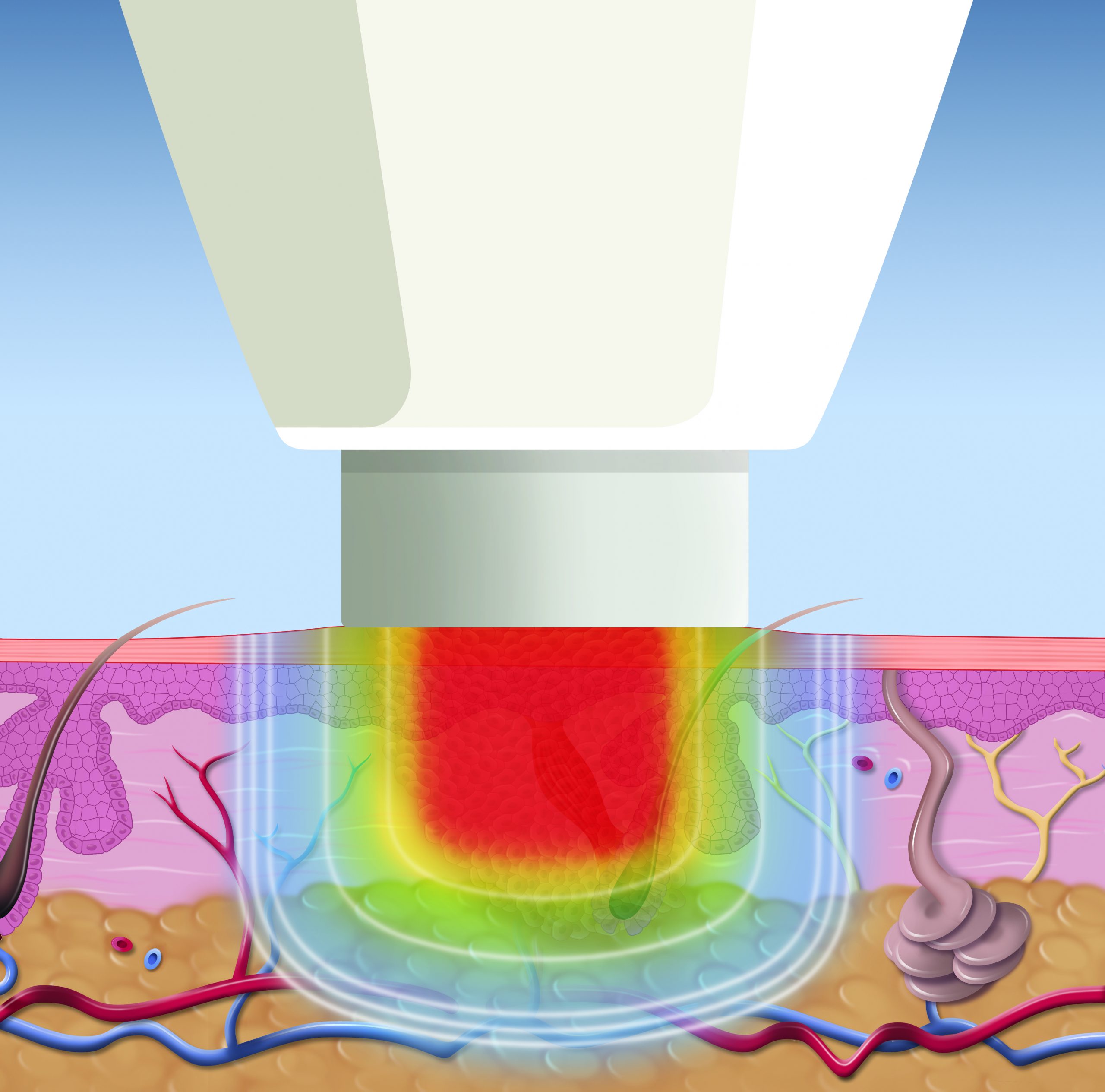 Swift Microwave Therapy Wart Treatment