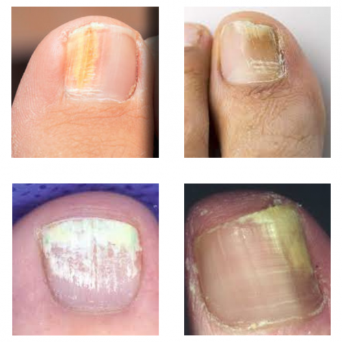 Fungal nail infection symptoms include discolouration of nails, expert  warns | Express.co.uk